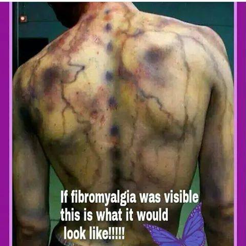 From Facebook support group "being positive with Fibromyalgia"